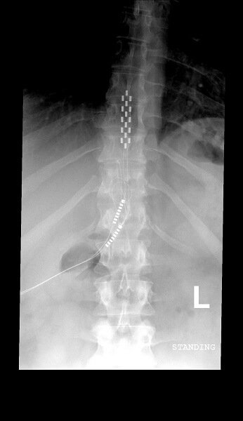 x-ray of a spine